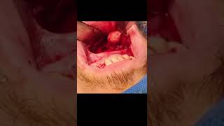 Mandible cyst removal [upl. by Odareg]