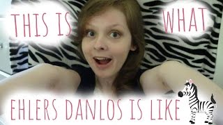 This Is What Ehlers Danlos Syndrome Is Like [upl. by Dyann]