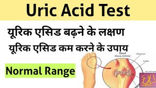 Uric Acid Test in Hindi  uric acid treatment  uric acid symptoms [upl. by Korfonta]