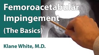 Femoroacetabular Impingement The Basics [upl. by Asin110]