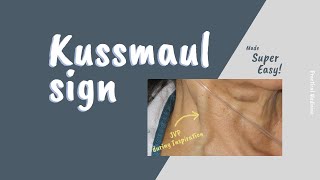 Kussmaul sign SIMPLIFIED FOR CLEAR UNDERSTANDING [upl. by Atikir]