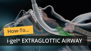 i gel Extraglottic Airway [upl. by Einotna]