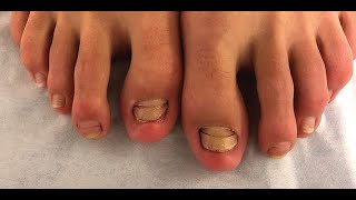 Antifungal Nail Cream  Toenail ​Fungus ​Cream Review [upl. by Melia725]