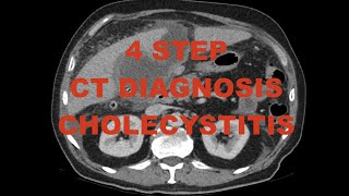 4 step diagnosis  Acute Cholecystitis on CT scan  case review with differential diagnoses [upl. by Adnuahsal]