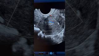 Endometrial Polyp Ultrasound with internal vascularity  ARDMS Sonography  obgyn [upl. by Anhsirk]