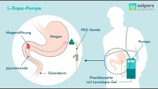 LDopa bei Parkinson Experte erklärt [upl. by Onej]