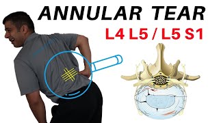 Annular Tear L4L5 L5S1 Disc Bulges [upl. by Aniara]