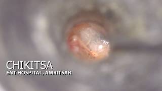 Microscopic Myringotomy [upl. by Aba]