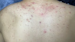 ACNE TREATMENT VU QUYNH MI  Acne On Back FULL [upl. by Dehnel]