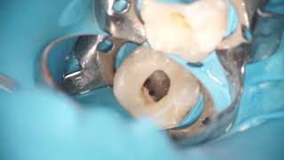 Mid Mesial Canal [upl. by Zenda]