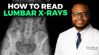 How to Read a Lumbar XRay [upl. by Elatan]