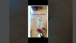 Hickman catheter [upl. by Bunni]