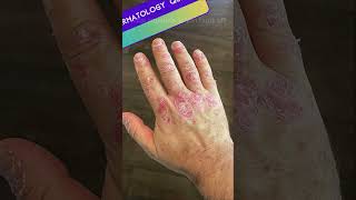 Dermatoses Resulting from Physical Factors Quiz  Part 2 medicalmcqs dermatologyquiz [upl. by Oraneg71]