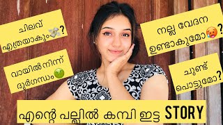 എന്റെ പല്ലിൽ കമ്പി ഇട്ട STORY😁🦷braces journeyMalayalam [upl. by Blas]