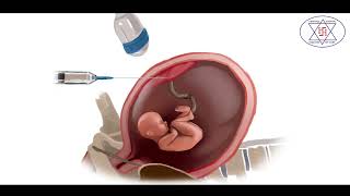 Genetic disorder diagnosis in pregnancy by Amniocentesis amp CVS Chorionic Villus Sampling [upl. by Ellered]