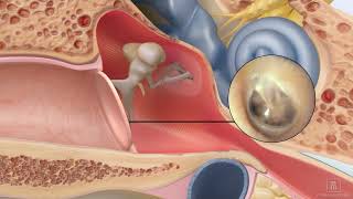 Repair a perforated ear drum using ClearDrum [upl. by Seroled719]