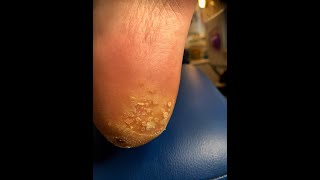 Getting rid of verrucas for good Plantar Wart Verruca Removal [upl. by Anaehr]