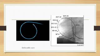 Intracardiac Dr lamiaa Allam [upl. by Stovall]