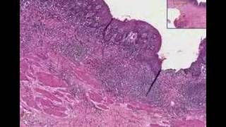 Histopathology EsophagusChronic esophagitis [upl. by Ninaj]