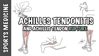 Achilles Tendonitis and Tendon Rupture  Overview [upl. by Inva]