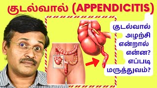 குடல்வால் அழற்சிக்கு ஆபரேஷன் செய்ய வேண்டுமா  appendicitis signs symptoms [upl. by Marvella]