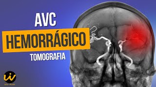 AVC HEMORRÁGICO com Sinais de Hidrocefalia Hipertensiva [upl. by Tebor]