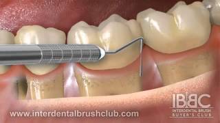 Periodontal disease causes and treatment [upl. by Sathrum]