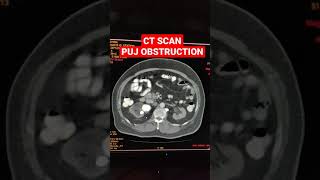 What is PUJ Obstruction  CT Scan for PUJ Obstruction [upl. by Otiragram895]