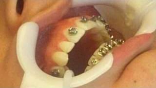 Orthodontist Places Braces on PatientSee how easy it is to get braces [upl. by Ellicott]