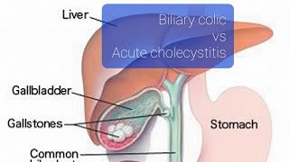 Biliary colic vs acute cholecystitis [upl. by Phillips533]