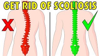 How to fix scoliosis naturally in 4 minutes a day [upl. by August]