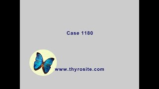 Case 1180  the right lobe [upl. by Reffinej]