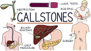 Understanding Gallstones [upl. by Ahsam983]