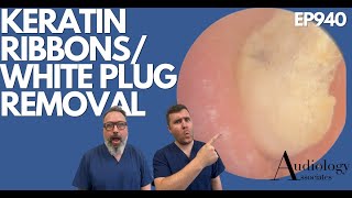 KERATIN RIBBONSEAR WAX amp WHITE PLUG REMOVAL FROM EAR  EP940 [upl. by Navak88]