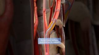 How carotid stenting prevents stroke a stepbystep guide to restoring blood flow [upl. by Ecital]