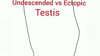 Undescended vs Ectopic Testis [upl. by Amble]