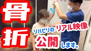 【公開】骨折のリハビリ映像！骨折を早く治す方法！腕の骨折リハビリのリアル映像！ [upl. by Otrebide261]