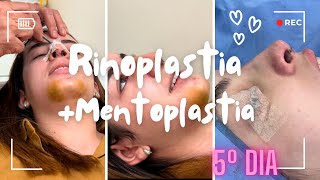 Rinoplastia  Mentoplastia  5º dia com remoção de curativo [upl. by Ettennad515]