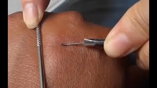 Splinter Removal Video  Nails in hand [upl. by Doroteya]