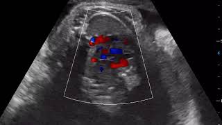 CASE 381 FETAL ECHO atrial septal defect ASD [upl. by Ttik]