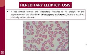 Hematology  2  U1L17  Hereditary elliptocytosis [upl. by Frazier]