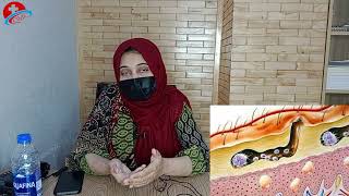 WHAT IS SCABIES II خارش کیا ہے؟ [upl. by Nyra]