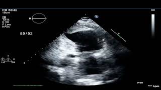 TTE Large Apical Thrombus  Post Infarct [upl. by Luapnaej]