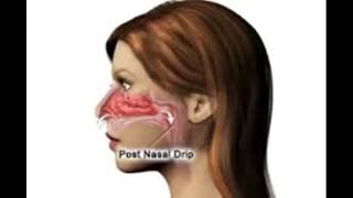 Wie zur Behandlung und Heilung post nasal drip [upl. by Mal435]