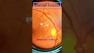 Normal fundus  Normal Retina  Smartphone Fundus Videography  Fundus Photography  Short Video 111 [upl. by Leval141]