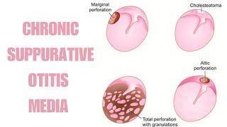 Chronic Suppurative Otitis Media  Part 3  Atticoantral Type Of CSOM [upl. by Ylliw43]