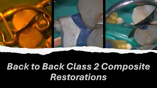 Back to Back Class 2 Composite Restorations [upl. by Atikahc]