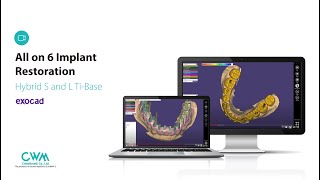 How to design All On 6 using InnoFit Hybrid S Ti Bases [upl. by Esac]