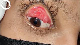 Giant Papillary Conjunctivitis [upl. by Aranahs]