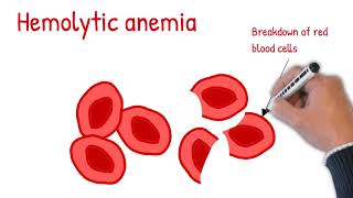 Hemolytic anemia made easy Intrinsic vs extrinsic hemolytic anemia [upl. by Lema]